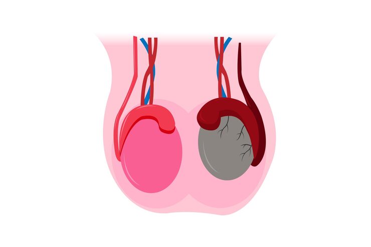 Torsion Testis